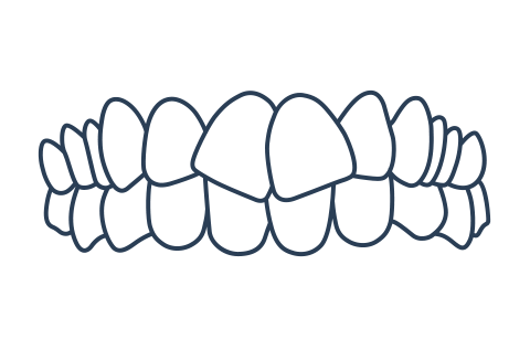 Generally straighter teeth example for Invisalign